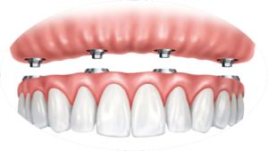 4 on 4 dentures