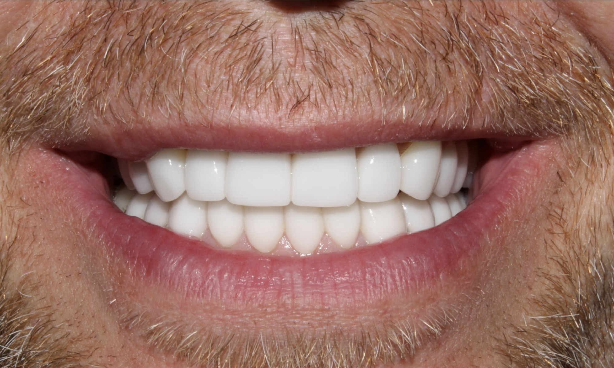 Cosmetic Dentist Before and after CDA Idaho