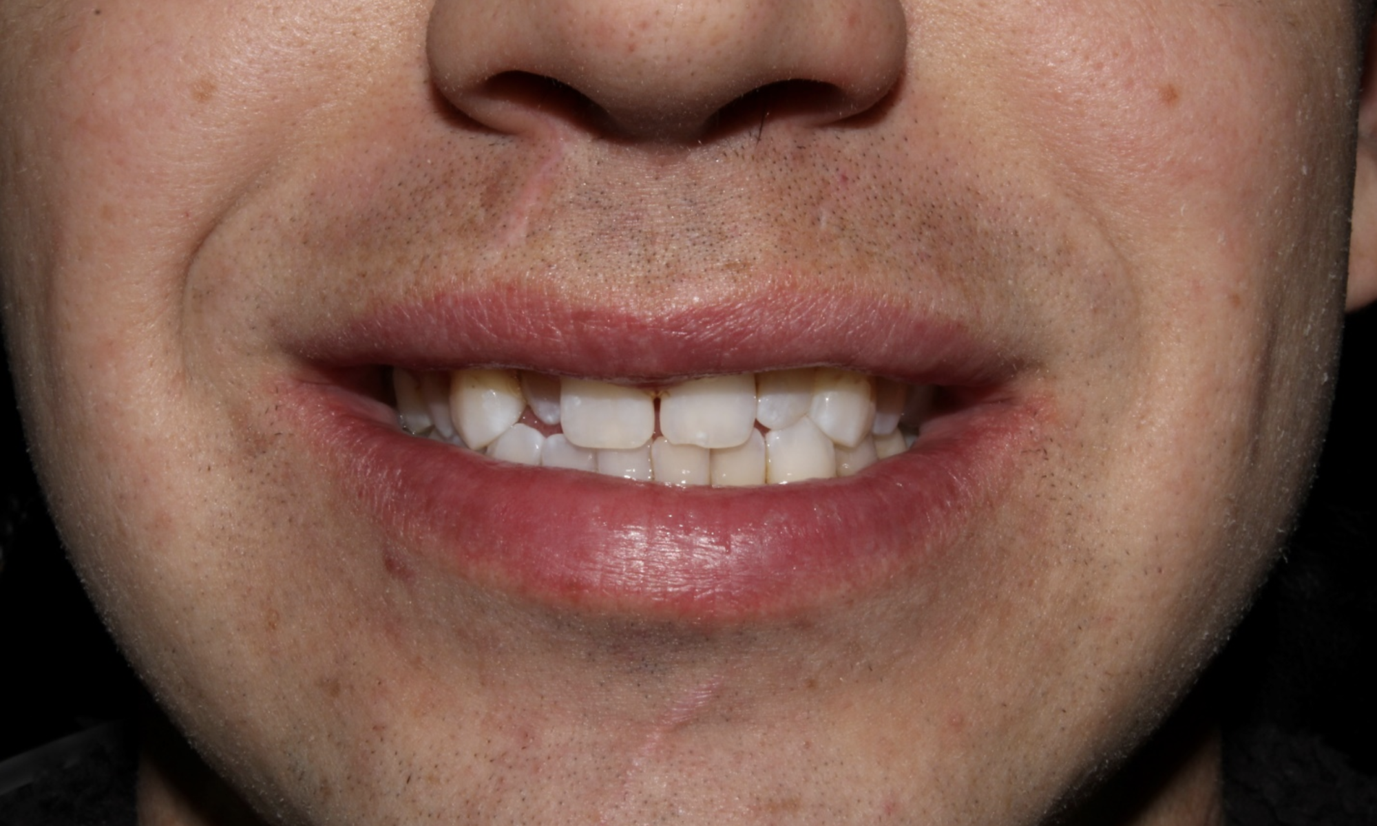 Cosmetic Dentist Before and after CDA Idaho