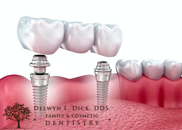 Benefits of an Implant-Supported Bridge cda idaho