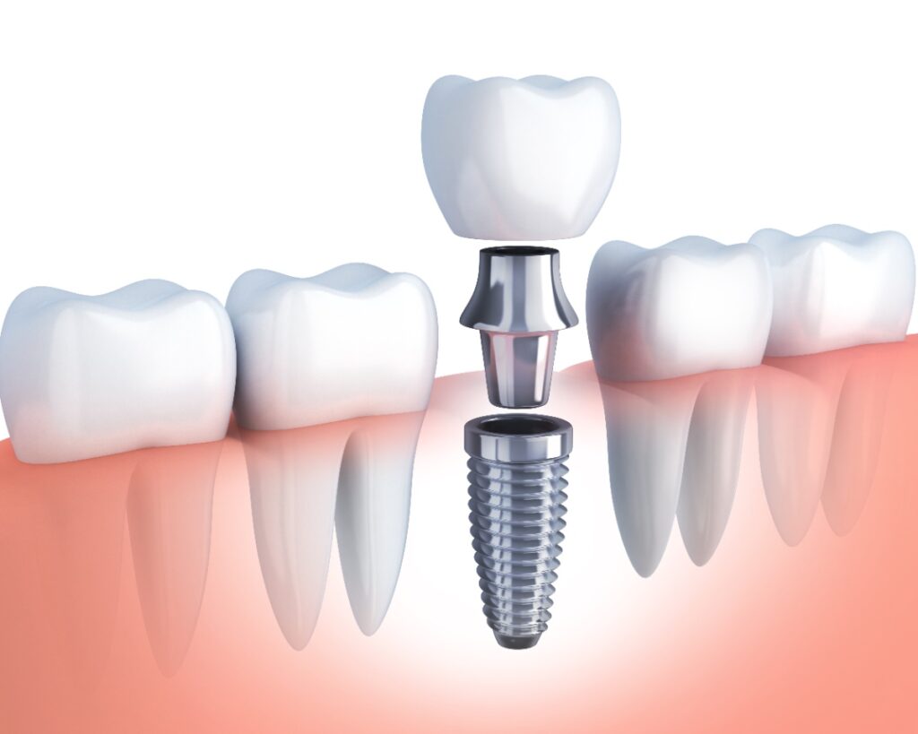 Why Are Dental Implants so Expensive? 1 Full mouth dental implants cost usa
Dr.Delwyn Dick (DDS)
Dr.Miranda Anderson (DDS)
Kootenai Dental Group, Coeur d'Alene, ID