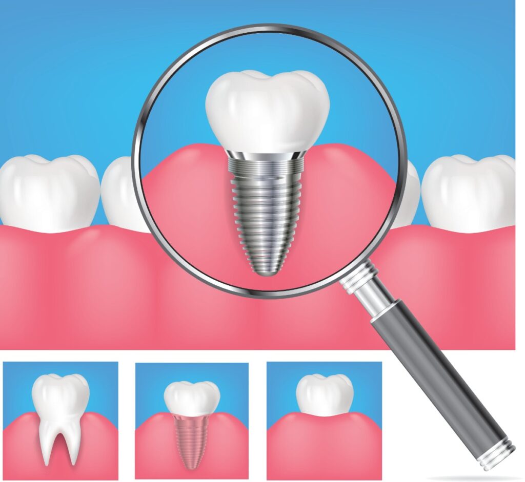 Types of Dental Implants (and Which One is the Best for You!) 1 how long does swelling last after dental implants Dr. Delwyn Dick (DDS) Dr. Miranda Anderson (DDS) Kootenai Dental Group, Coeur d'Alene, ID