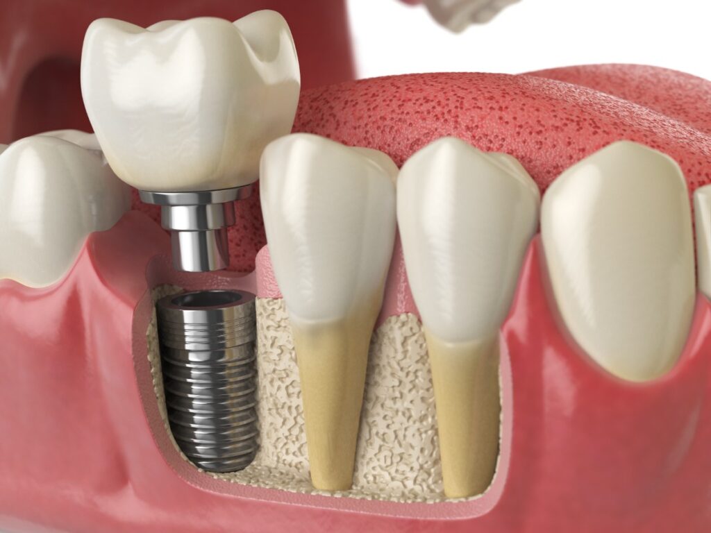 Truth about dental implants
Dr.Delwyn Dick (DDS) 
Dr.Miranda Anderson (DDS) 
Kootenai Dental Group, Coeur d'Alene, ID
