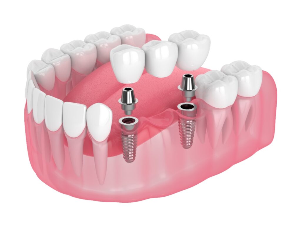 How Long Do Dental Implants Take? 1 Tooth extraction and implant timeline
Dental implant procedure steps
Dr. Delwyn Dick (DDS)
Dr. Miranda Anderson (DDS)
Kootenai Dental Group, Coeur d'Alene, ID