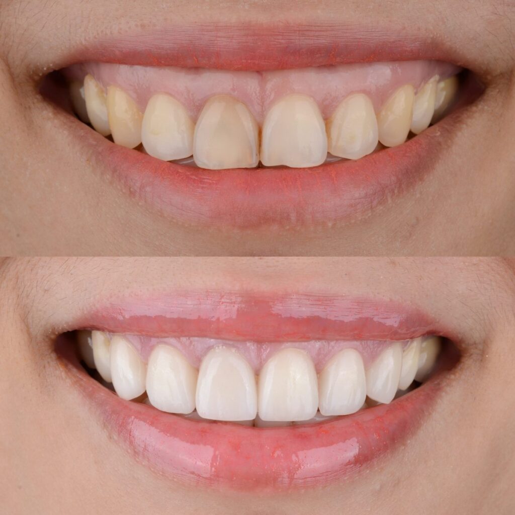 How Long do Veneers Last? 1 How long do veneers last before and after
Dr. Delwyn Dick (DDS)
Dr. Miranda Anderson (DDS)
Kootenai Dental Group, Coeur d'Alene, ID