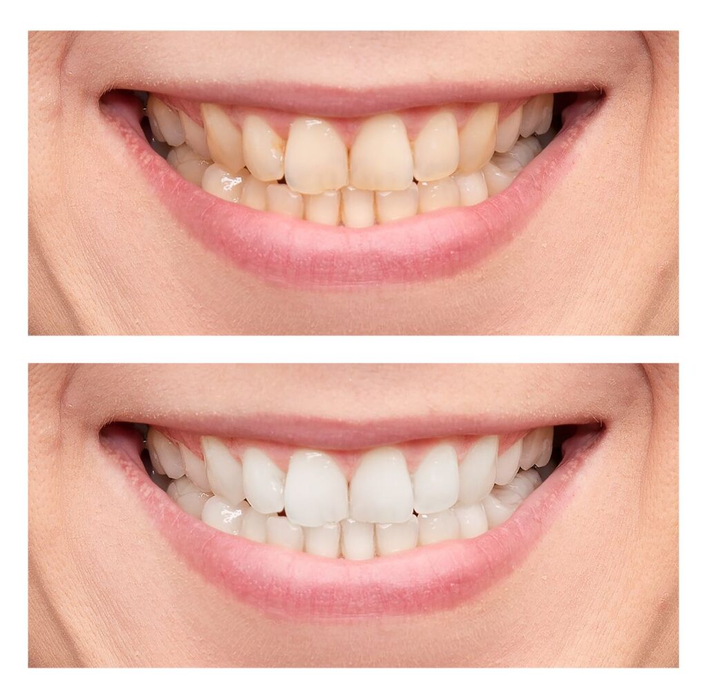 How long does led teeth whitening last
Dr. Delwyn Dick (DDS) 
Dr. Miranda Anderson (DDS) 
Kootenai Dental Group, Coeur d'Alene, ID
