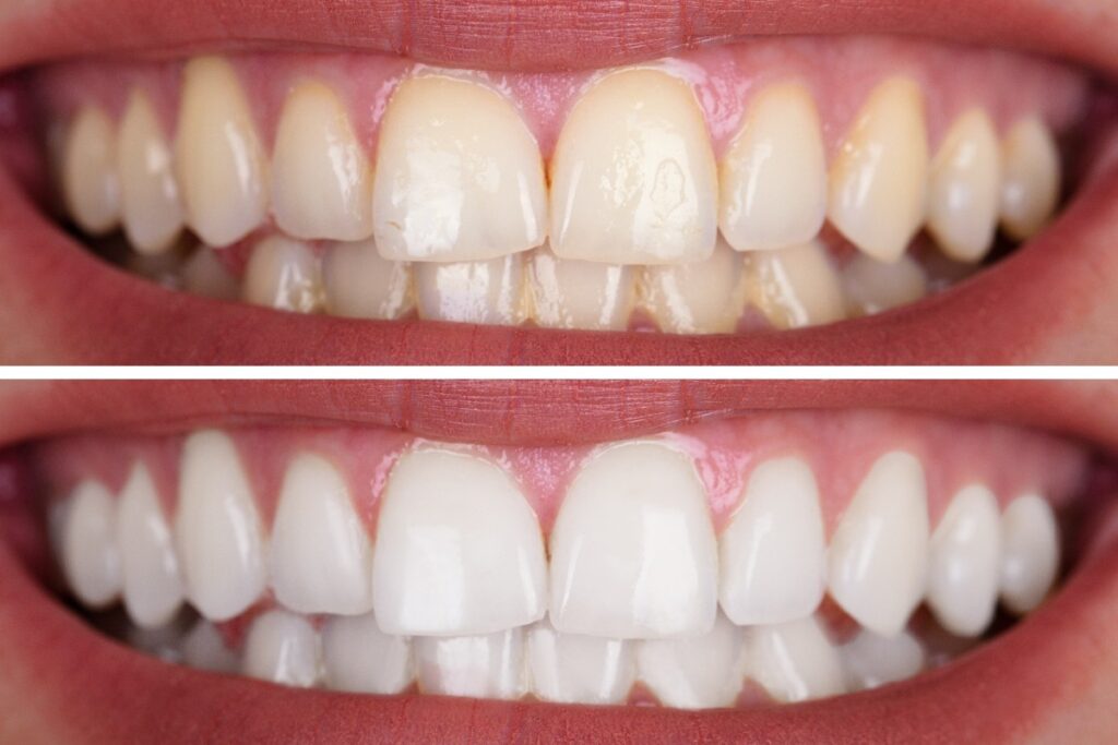 What Can I Eat After Teeth Whitening? 1 Foods to avoid after teeth whitening
Dr. Delwyn Dick (DDS)
Dr. Miranda Anderson (DDS)
Kootenai Dental Group, Coeur d'Alene, ID