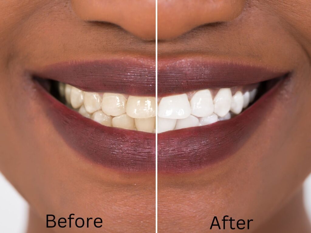 Is Teeth Whitening Permanent? 1 best teeth whitening kits
Dr. Delwyn Dick (DDS)
Dr. Miranda Anderson (DDS)
Kootenai Dental Group, Coeur d'Alene, ID