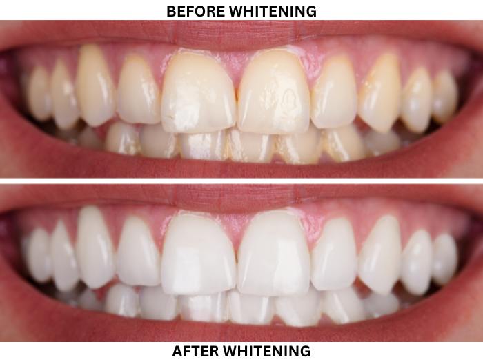How to Whiten Sensitive Teeth 1 professional teeth whitening for sensitive teeth
Dr. Delwyn Dick (DDS)
Dr. Miranda Anderson (DDS)
Kootenai Dental Group, Coeur d'Alene, ID