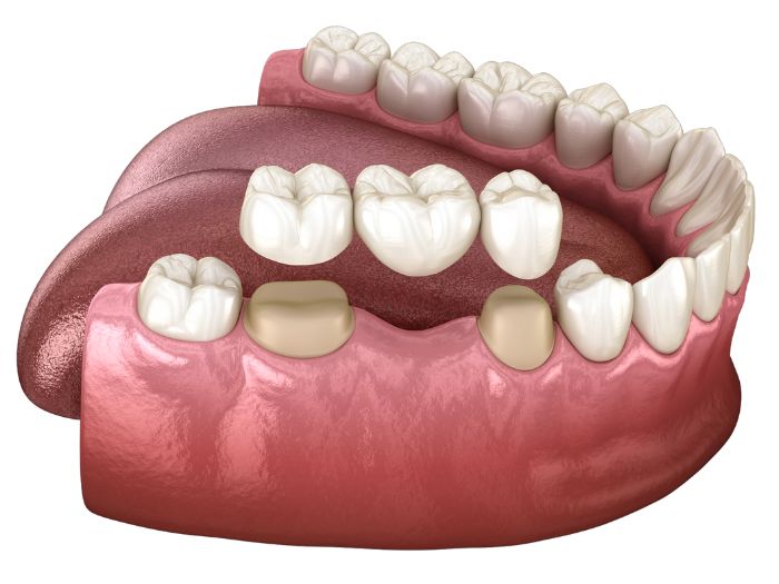 How Long do Dental Bridges Last? 1 can a dental bridge be removed and recemented
Dr. Delwyn Dick (DDS)
Dr. Miranda Anderson (DDS)
Kootenai Dental Group, Coeur d'Alene, ID