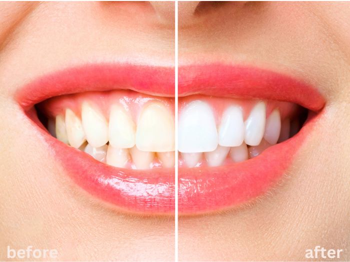How Often Can I Safely Whiten my Teeth? 1 how often can you whiten your teeth
Dr. Delwyn Dick (DDS)
Dr. Miranda Anderson (DDS)
Kootenai Dental Group, Coeur d'Alene, ID