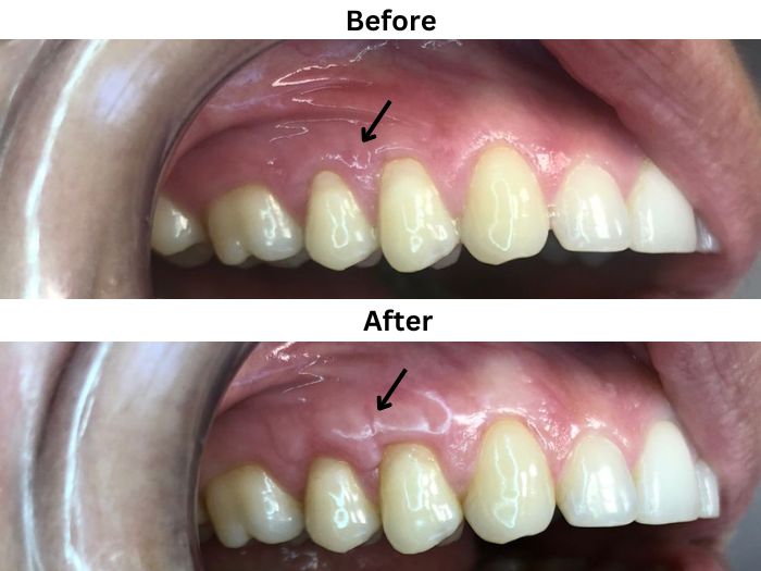 Is a Gum Graft Worth It? 1 gum graft before and after
Dr. Delwyn Dick (DDS)
Dr. Miranda Anderson (DDS)
Kootenai Dental Group, Coeur d'Alene, ID