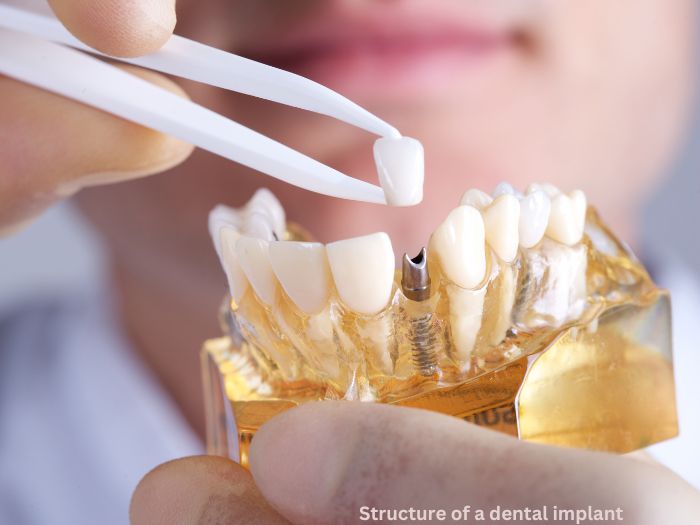 Your Dental Implant Feels Loose? Here’s What to Do! 1 what to do if your implant feels loose
Dr. Delwyn Dick (DDS)
Dr. Miranda Anderson (DDS)
Kootenai Dental Group, Coeur d'Alene, ID