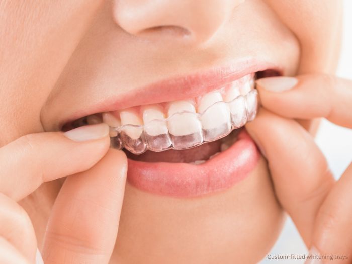 Are Teeth Whitening Strips Bad? 1 Are whitening strips bad
Dr. Delwyn Dick (DDS)
Dr. Miranda Anderson (DDS)
Kootenai Dental Group, Coeur d'Alene, ID