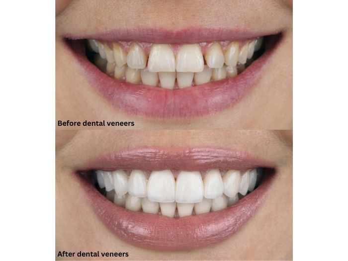 Can You Go Back to Your Regular Teeth After Veneers? 1 can you go back to regular teeth after dental veneers
Dr. Delwyn Dick (DDS)
Dr. Miranda Anderson (DDS)
Kootenai Dental Group, Coeur d'Alene, ID