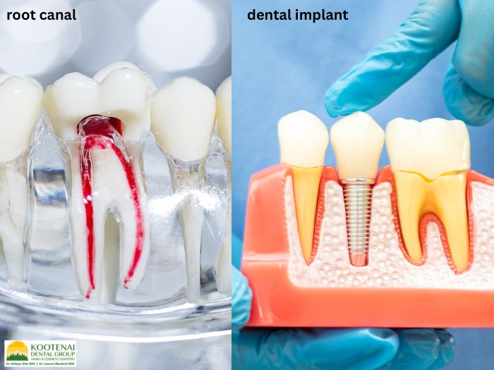 Are Dental Implants Healthier Than Root Canals? 1 Root canal vs. Dental implant
Dr. Delwyn Dick (DDS)
Kootenai Dental Group, Coeur d'Alene, ID