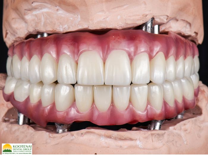 Can You Get Multiple Dental Implants at the Same Time? 1 Can you get multiple dental implants at the same time?
Dr. Delwyn Dick (DDS)
Kootenai Dental Group, Coeur d'Alene, ID