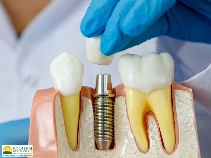 Can I Get a Dental Implant If I’ve Been Missing Teeth for a Long Time? 1 can you get dental implants if you have no teeth
Dr. Delwyn Dick (DDS)
Kootenai Dental Group, Coeur d'Alene, ID