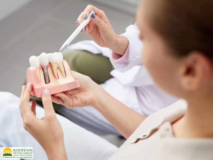 Do Dental Implants Require Special Maintenance? 1 Do dental implants require special maintenance
Dr. Delwyn Dick (DDS)
Kootenai Dental Group, Coeur d'Alene, ID