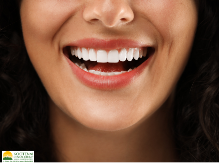 How Many Dental Veneers Can Be Placed at One Time? 1 How many veneers can be placed at once Dr. Delwyn Dick, DDS Kootenai Dental Group Coeur d'Alene, ID