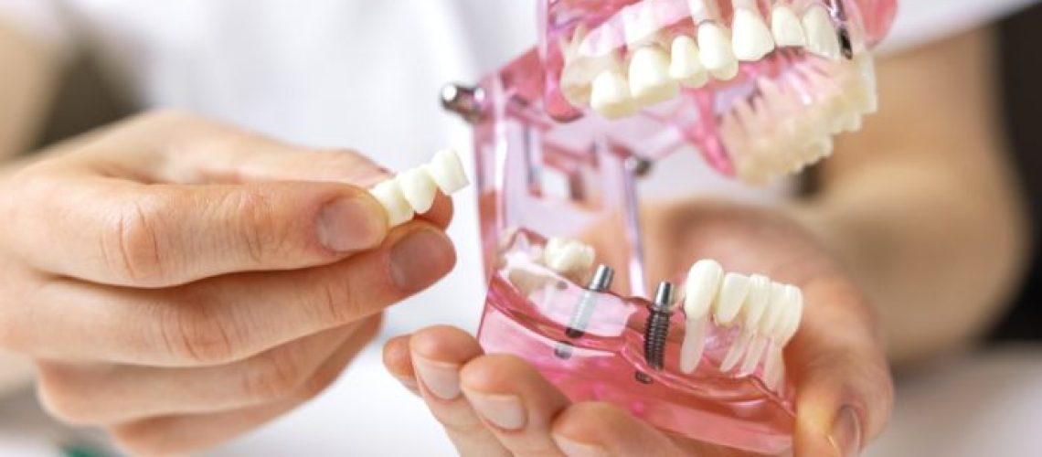 How Long do Dental Bridges Last?