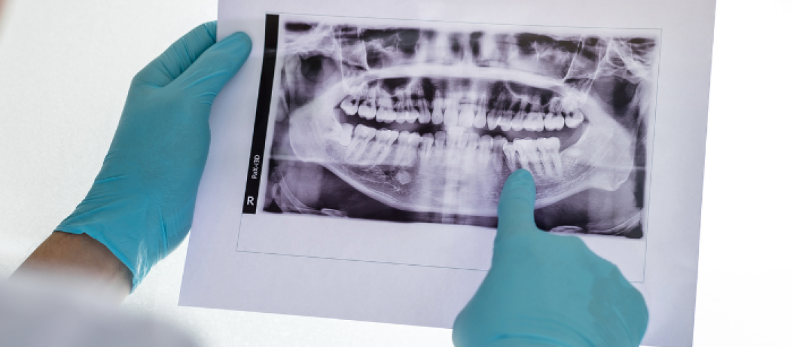 Do I Need Special Scans Before Getting A Dental Implant Dr. Delwyn Dick, DDS Kootenai Dental Group Coeur d'Alene, ID