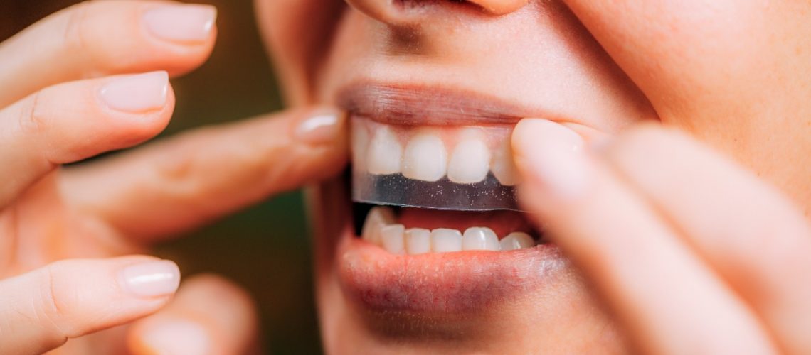 How long does teeth whitening last?