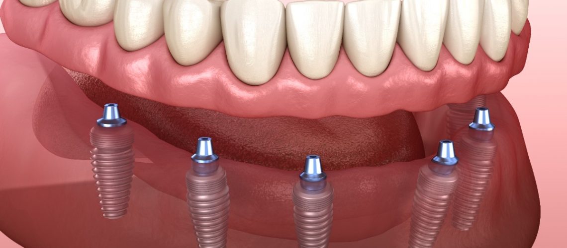 What is an implant-supported denture